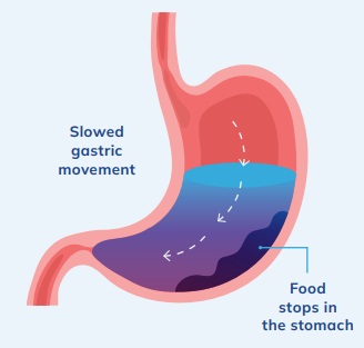 Gastroparesis, , also known as delayed gastric emptying (GE), affects the normal movement of the stomach muscles. Normally, the stomach empties soon after eating. With gastroparesis, it takes food much longer to leave the stomach. Delayed emptying can cause poor breakdown of food and uncomfortable symptoms.